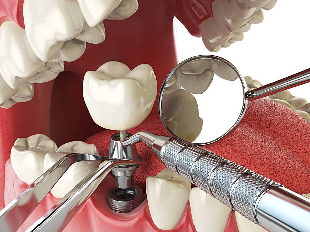 Best Emergency Root Canal Treatment in Bartlesville, OK